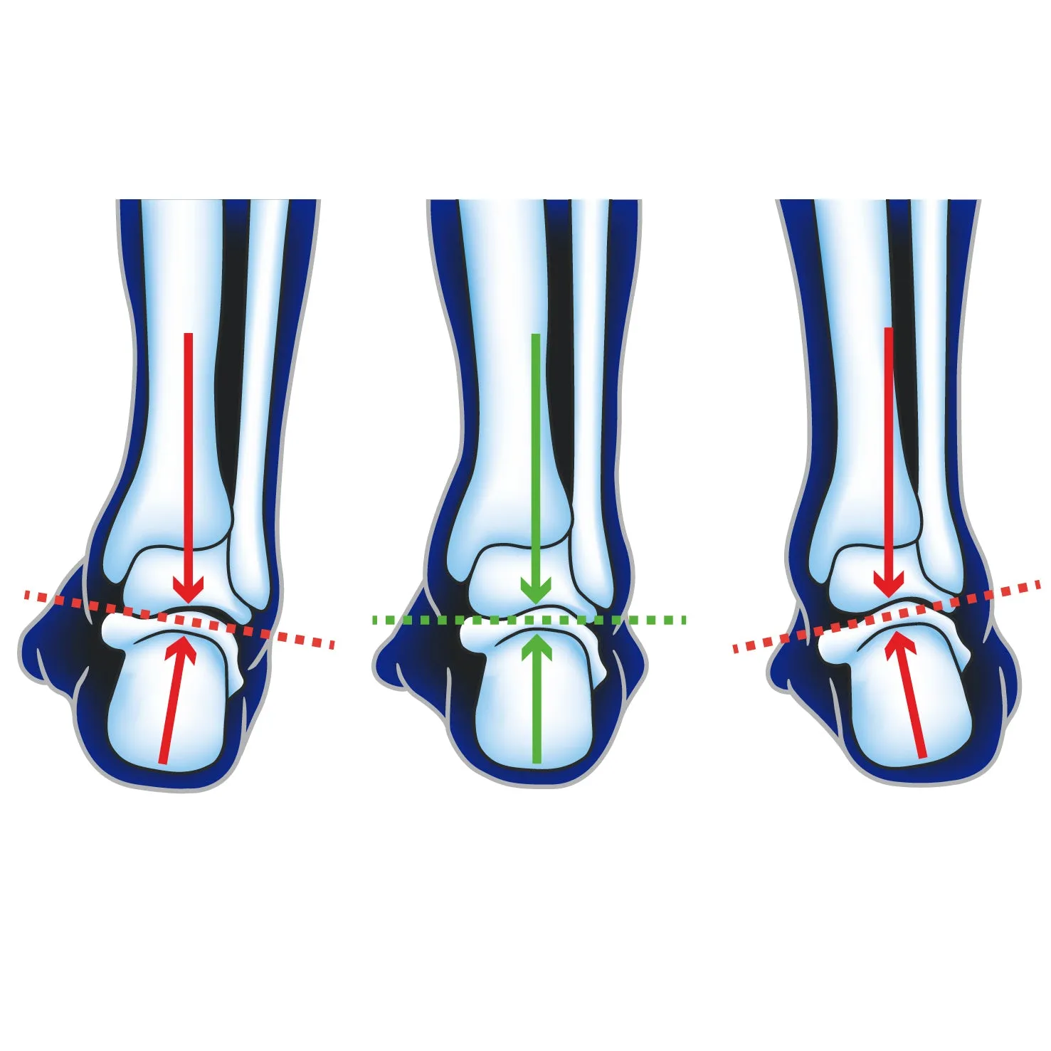 Ultimate Performance Advanced F3D Support  Insole